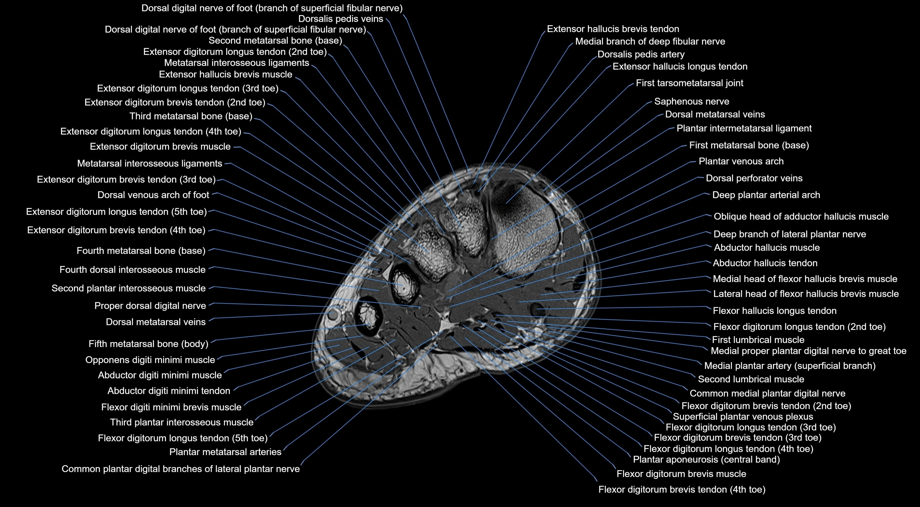 MRI mid foot coronal ligaments cross sectional anatomy 3T  radiology  image-img-00001-00011.webp